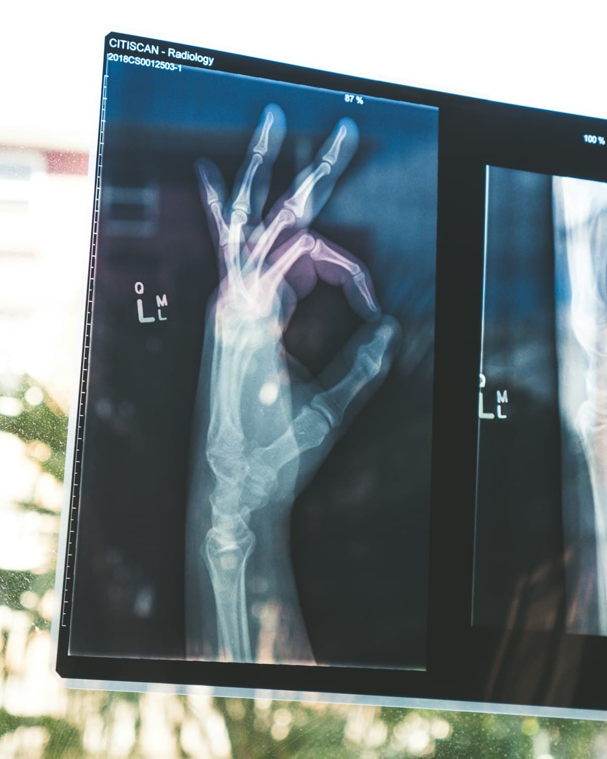 A hand X-ray displayed on a viewing screen
